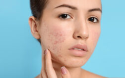 acne-banner-Recovered