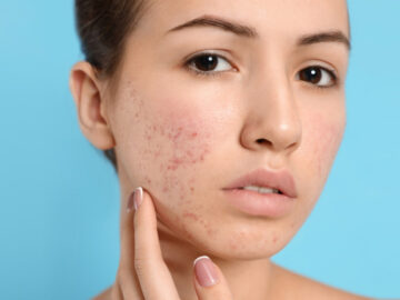 acne-banner-Recovered